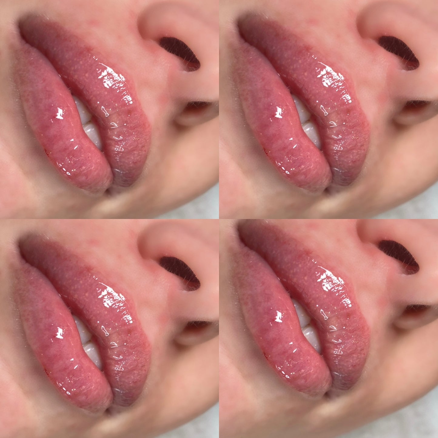 Lip Enhancement