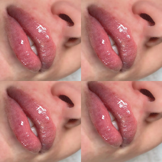Russian Lip Technique (Cannula Method)