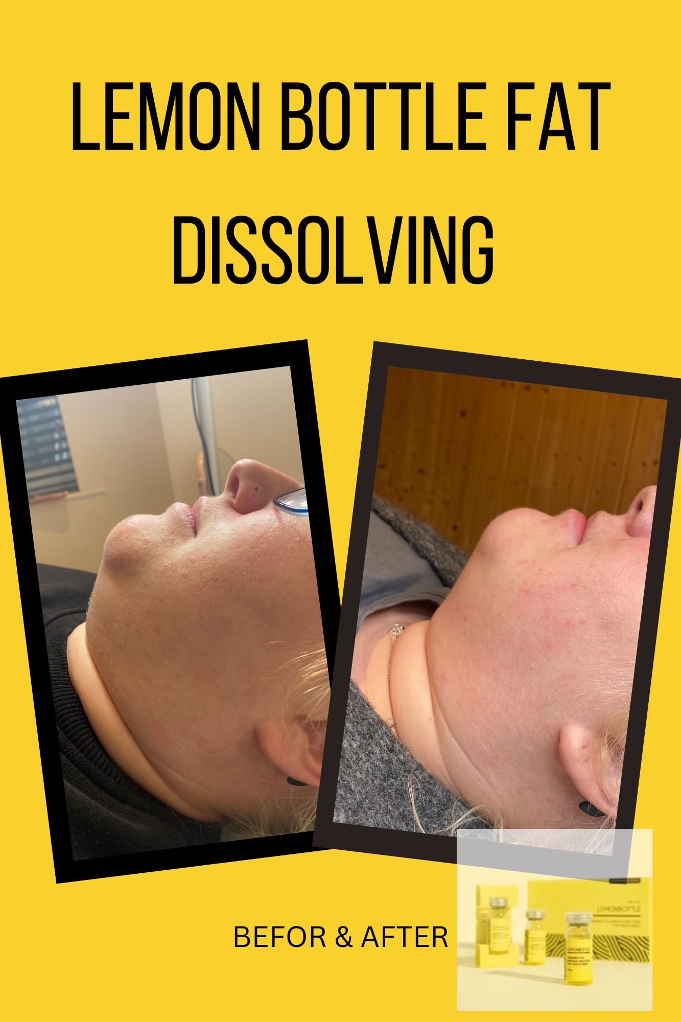 Fat Dissolving Course | 1 Day Beauty Course | Burnley LW Training Academy Fat Dissolving Course | 1 Day Beauty Course | Burnley LW Training Academy